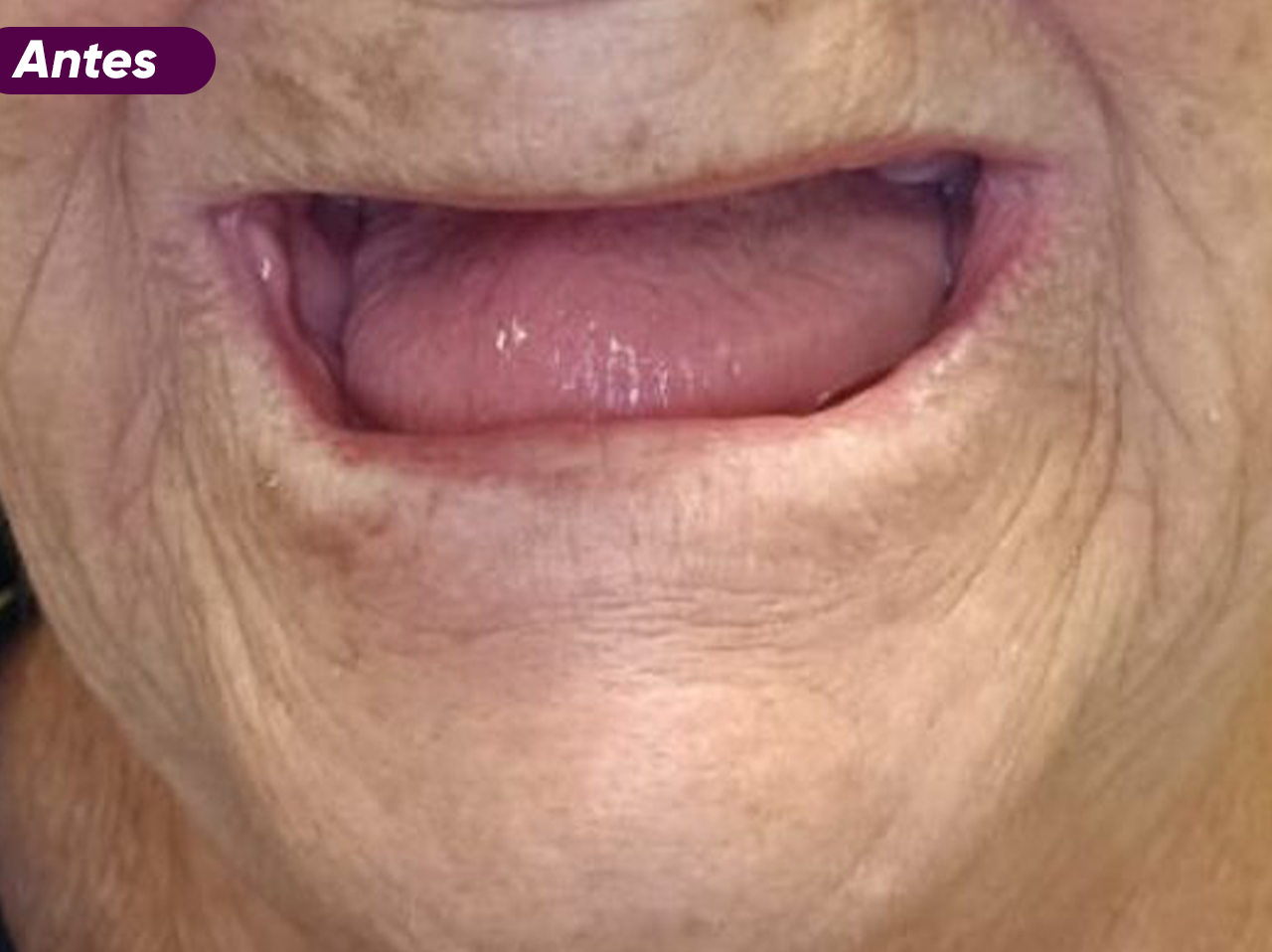 ANTES